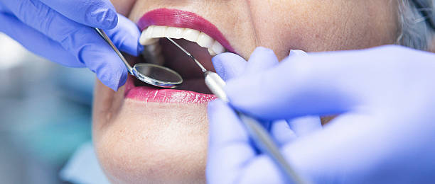 Best Emergency Dentist for Lost Fillings or Crowns in Corydon, IN